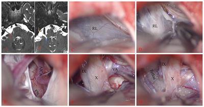 Case report: Significance of the large rhomboid lip in microvascular decompression: insights from two clinical cases